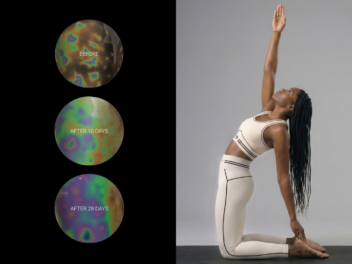 Progress of subcutaneous microcirculation after 28 days of consistent use of BeGood leggings